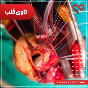عمل تاوی (tavi) قلب