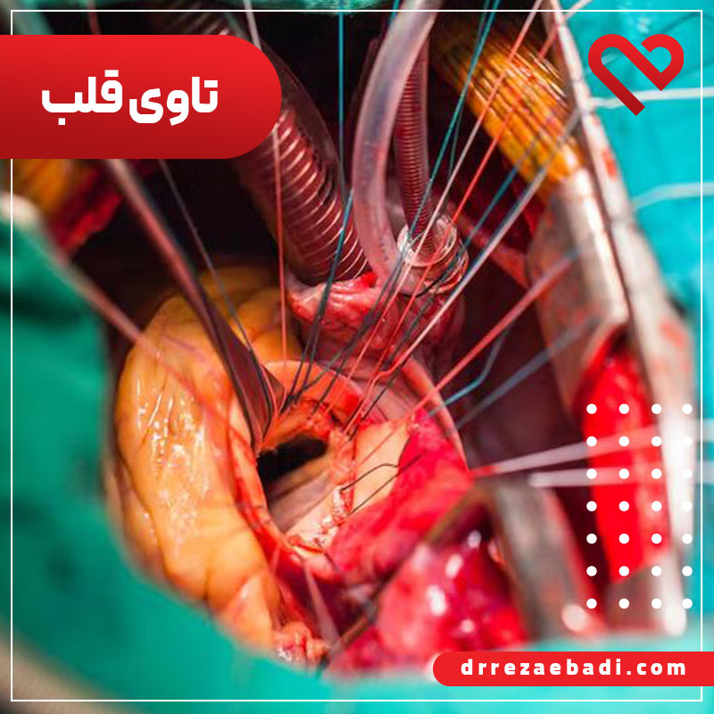 عمل تاوی (tavi) قلب